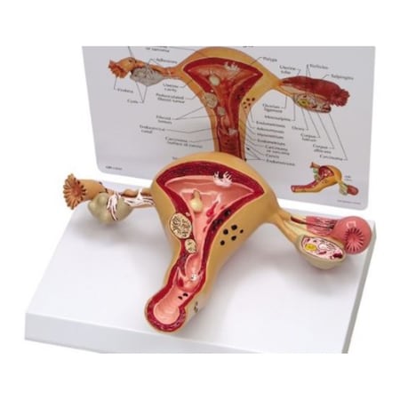 Anatomical Model - Uterus - Ovary
